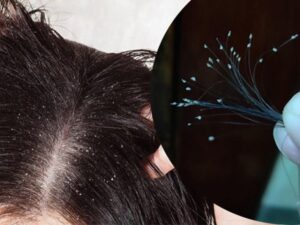 Chân tóc có hạt trắng nhỏ: Đó là bã nhờn hay nang tóc bị mất?